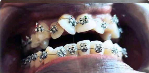 Before Braces Treatment